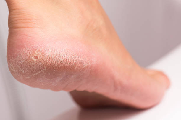 istock Female heel with hardened skin. 905884542