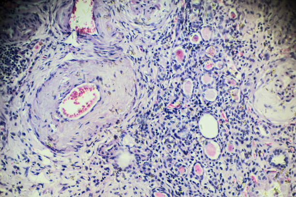 istock Hypertension disease renal different area under microscopy 905894360