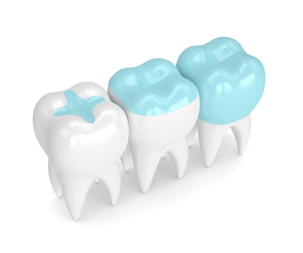 3d render of teeth with different types of filling 3d render of teeth with inlay, onlay and crown filling over white background inlay stock pictures, royalty-free photos & images