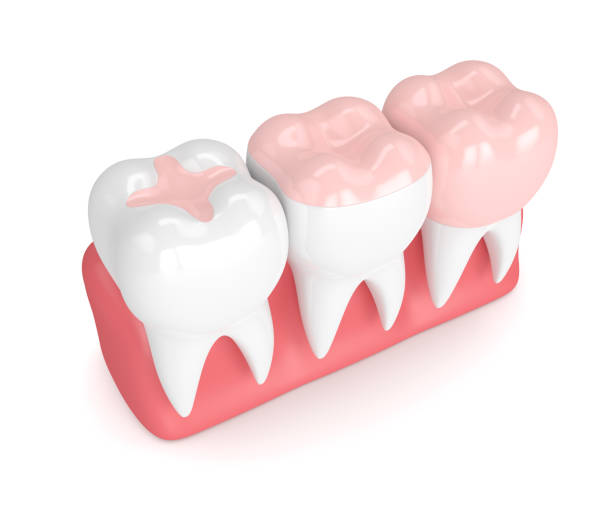 istock 3d render of teeth with different types of filling 905944478