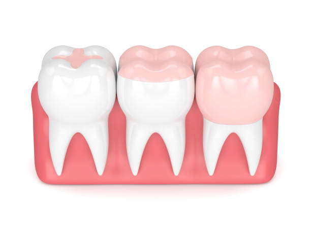 istock 3d render of teeth with different types of filling 905944910