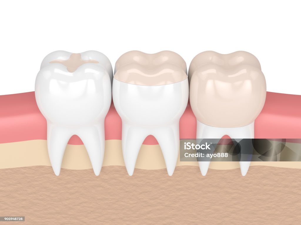 3D Rendering der Zähne mit verschiedener Füllung - Lizenzfrei Zahnpflege Stock-Foto