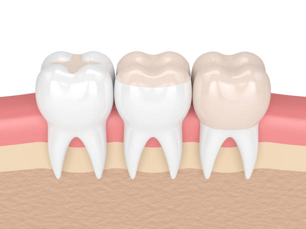 3d render of teeth with different types of filling 3d render of teeth with inlay, onlay and crown filling in gums inlay stock pictures, royalty-free photos & images