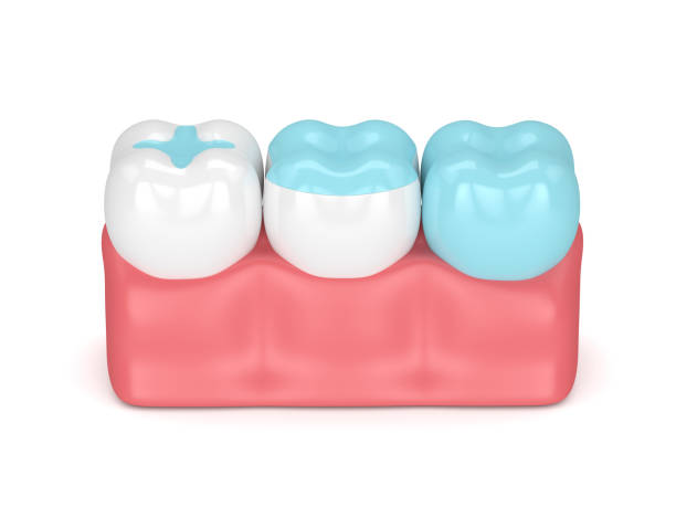 istock 3d render of teeth with different types of filling 905949574