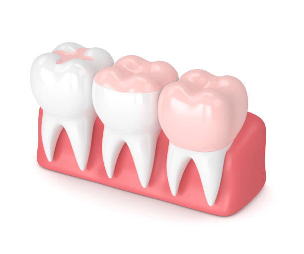 istock 3d render of teeth with different types of filling 905949890