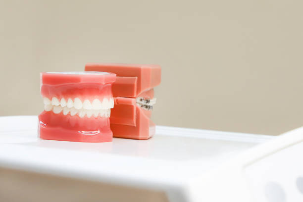 istock Perfectly straight teeth. Jaw model, close up. Braces on the teeth. 905960098