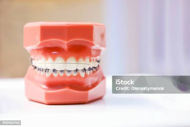 Perfekt Gerade Zähne Kiefermodell Nahaufnahme Klammern An Den Zähnen Stockfoto und mehr Bilder von Zahnspange
