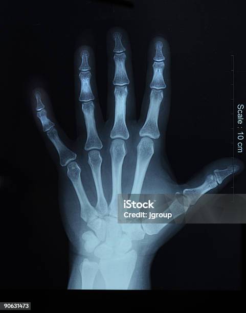 Xray Of Hand Top View Stock Photo - Download Image Now - Anatomy, Arthritis, Bone Fracture