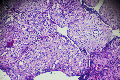 Ovary cystadenoma biopsy under light microscopy zoom in different area