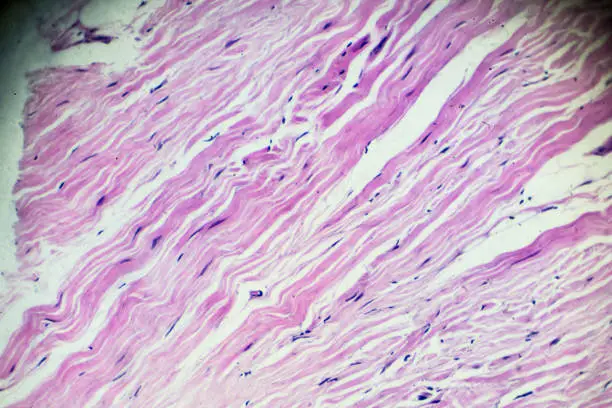 Connective tissue, hyaline degeneration biopsy under light microscopy zoom in different areas