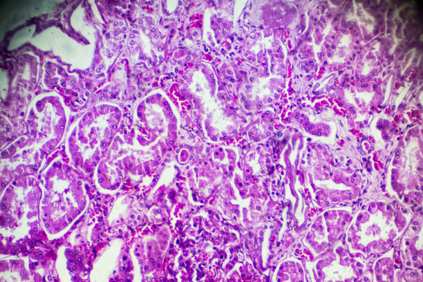 istock Kidney proximal tubule epithelial cloudy SWELLING 906577972