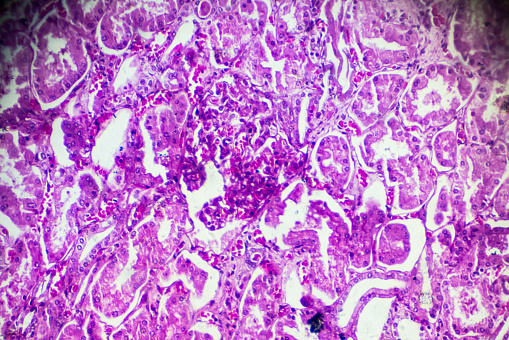 Kidney proximal tubule epithelial cloudy SWELLING under different area in light microscopyKidney proximal tubule epithelial cloudy SWELLING under different area in light microscopyKidney proximal tubule epithelial cloudy SWELLING under different area in light microscopy