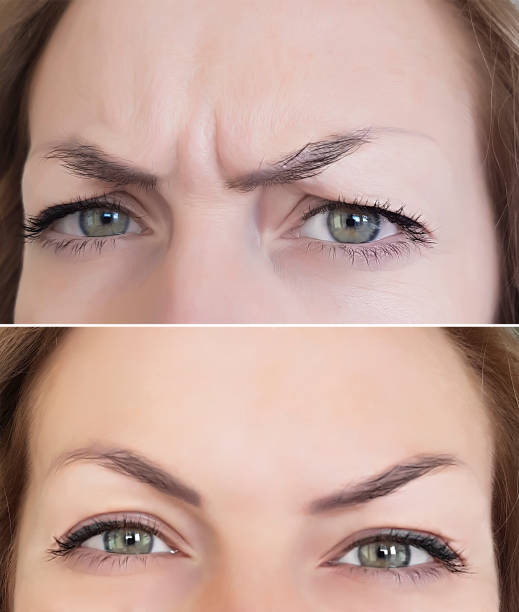 face woman wrinkles before and after eyes face woman wrinkles before and after the forehead botox botox before and after stock pictures, royalty-free photos & images