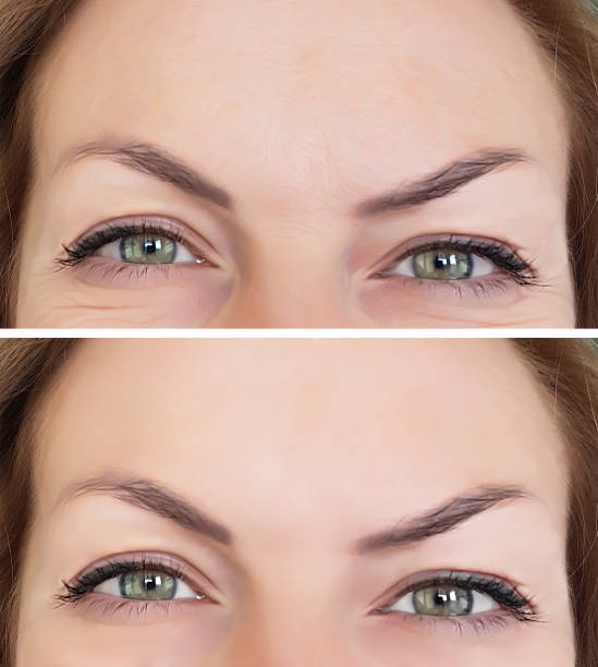 istock face woman wrinkles before and after the forehead 906641326