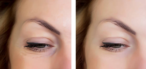istock face woman wrinkles before and after eyes 906641350