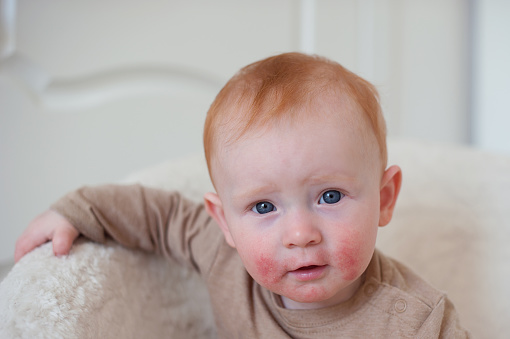 Bebé con dermatitis atópica photo
