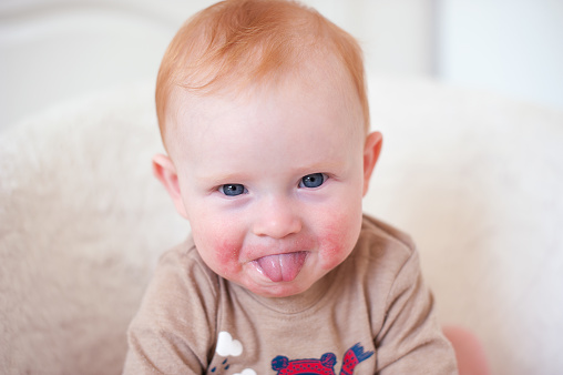 A child with an allergy on his face shows his tongue