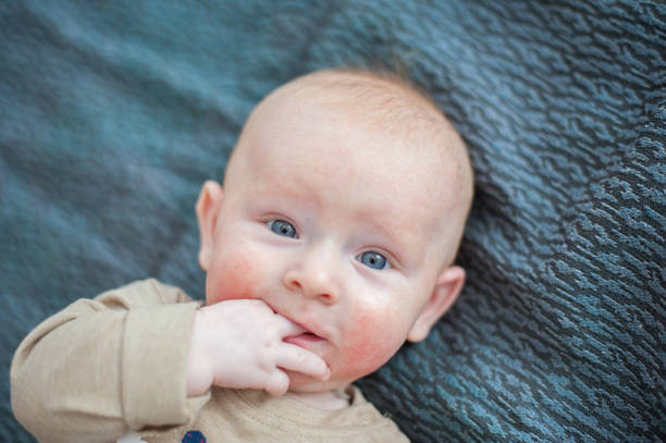 Red-haired boy with atopic dermatitis Red-haired boy with atopic dermatitis sucking finger dermatitis photos stock pictures, royalty-free photos & images