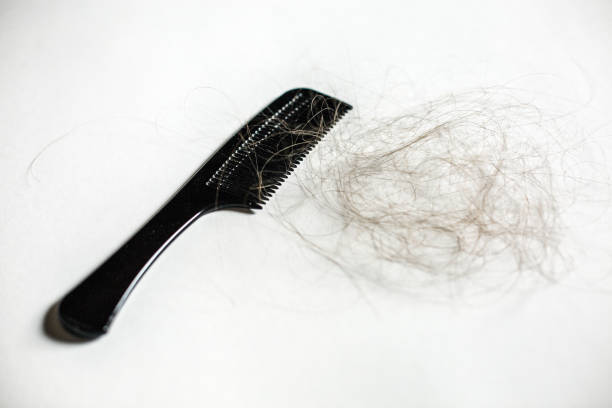 istock Hair in the comb, a problem with hair loss 906668884