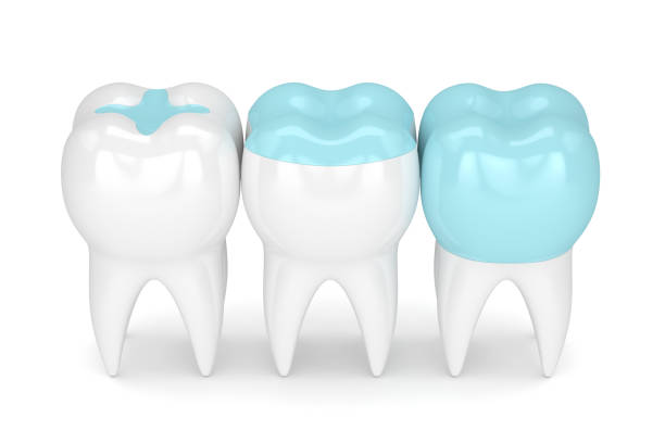 istock 3d render of teeth with different types of filling 906734066