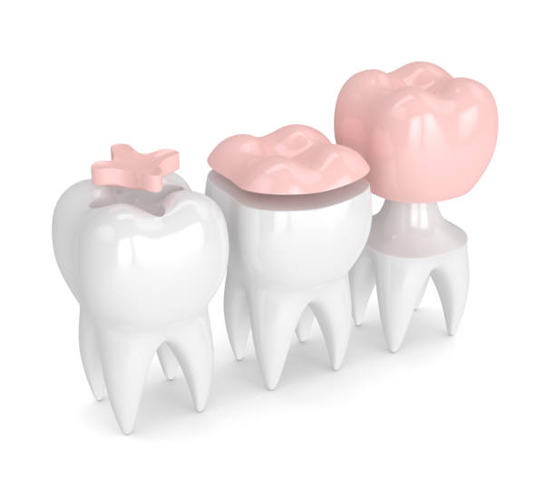 istock 3d render of teeth with different types of filling 906735338