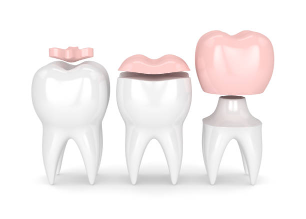 3d render of teeth with different types of filling 3d render of teeth with inlay, onlay and crown filling over white background inlay stock pictures, royalty-free photos & images