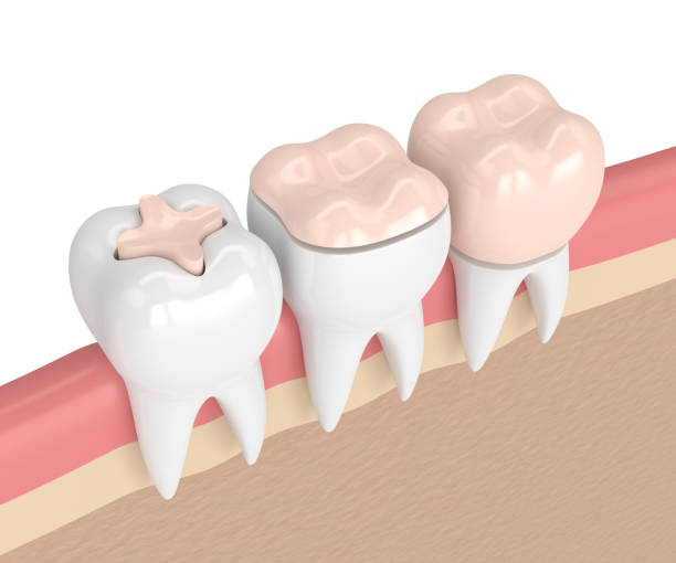 3d render of teeth with different types of dental filling stock photo