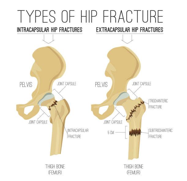 illustrations, cliparts, dessins animés et icônes de types de fractures de la hanche - hip femur ilium pelvis