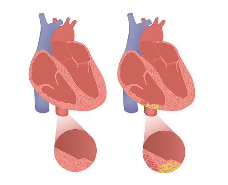 Healthy heart with arrhythmogenic cardiomyopathy. Vector illustration of arrhytmogenic right ventricular dysplasia