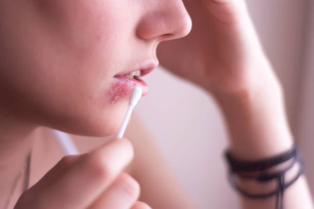Herpes Female face with herpes on the lips herpes stock pictures, royalty-free photos & images