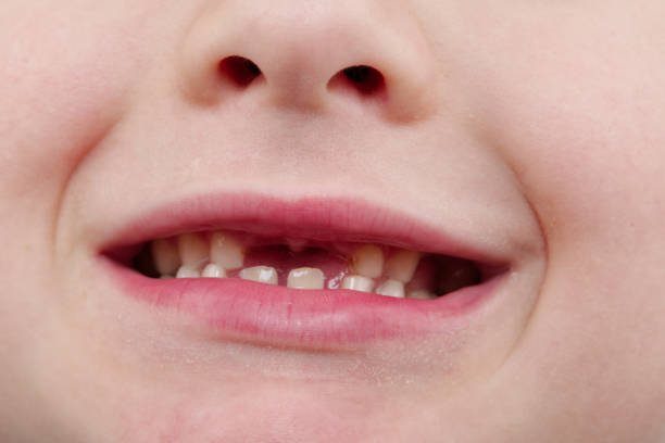 istock Happy handsome boy showing his changing teeth 907645220