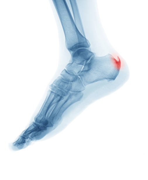 x-ray image of foot, lateral view showing heel spur or cancaneal spur human foot stock pictures, royalty-free photos & images