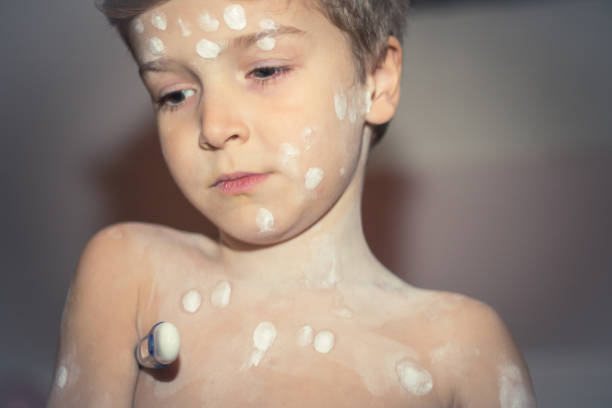 istock Little boy with chickenpox measuring temperature. 907787796