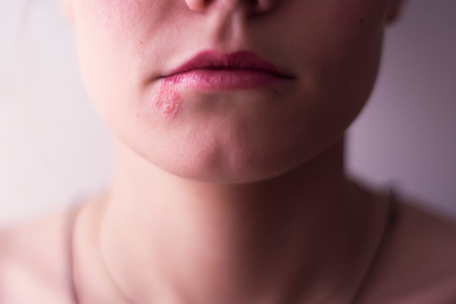 Female face with herpes on the lips