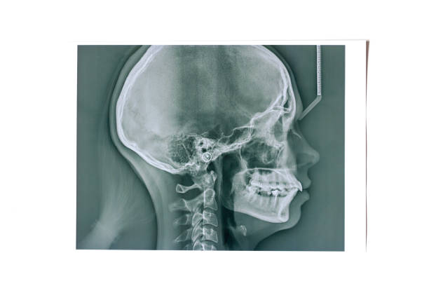 Teleradiography of the lateral side of the skull with an incorrect bite. X-ray for diagnosis of dentition on white background. Isolated. stock photo