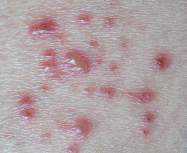istock Skin infected Herpes zoster virus. 907986478