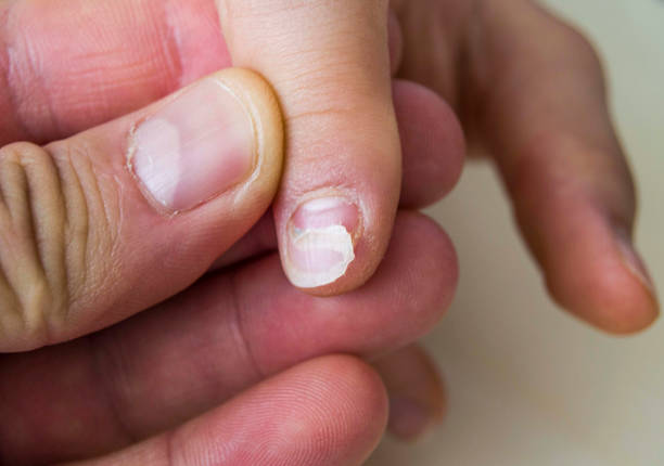 istock After febrile illness in children and infants fall nails, nail changes, 907992804