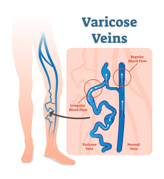 Varicose Veins With Irregular Blood Flow And Healthy Veins Vector  Illustration Diagram Scheme Stock Illustration - Download Image Now - iStock