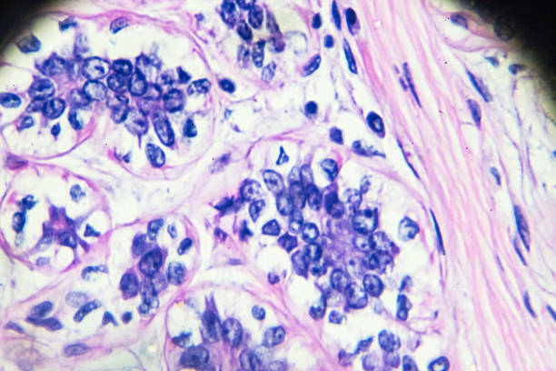 cáncer de mama bajo microscopia ligera - microscope slide fotografías e imágenes de stock