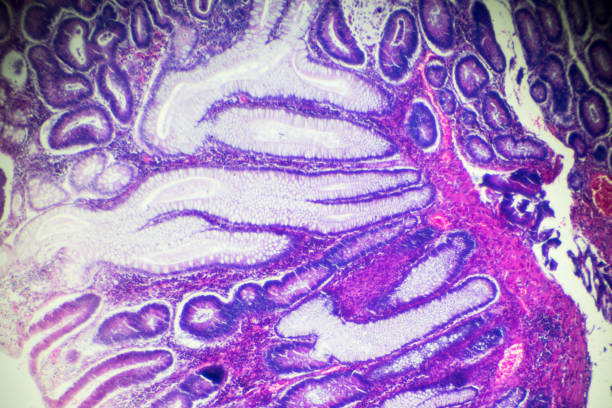 암 장 (잘 diff. 관상 선 암) 현미경의 - submucosa 뉴스 사진 이미지