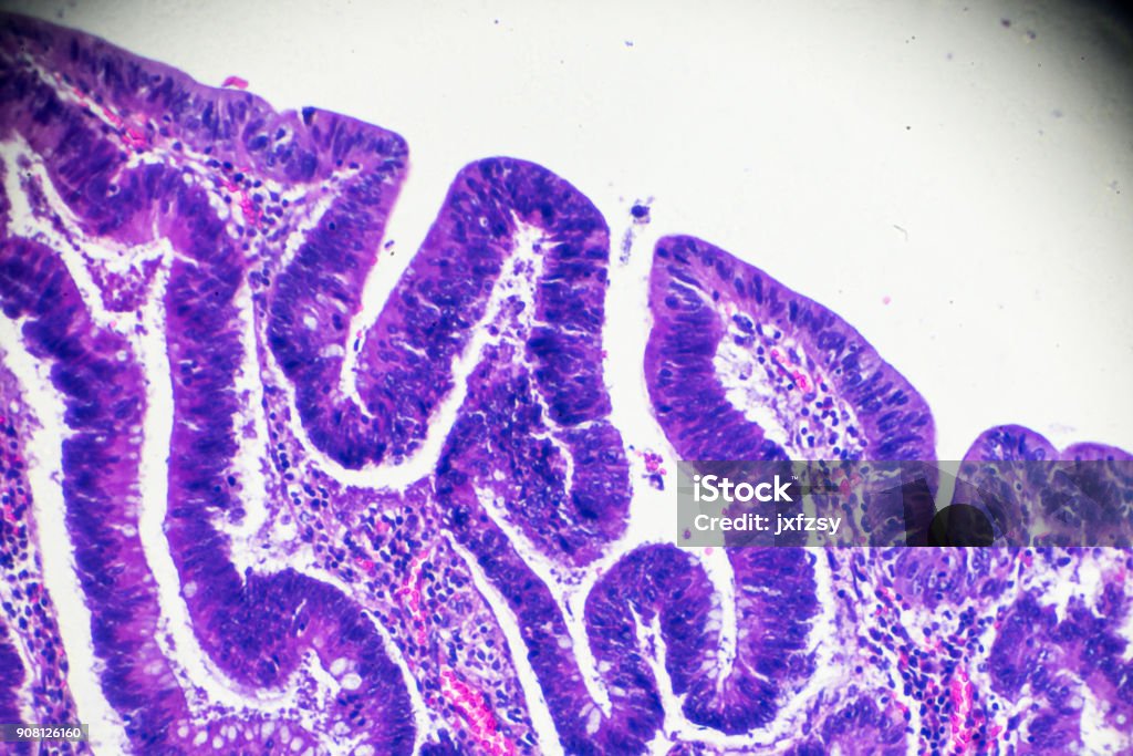Carcinoma of the large intestine (well diff. tubular adenocarcinoma) under microscope Carcinoma of the large intestine (well diff. tubular adenocarcinoma) under microscope zoom in different areas Adenocarcinoma Stock Photo