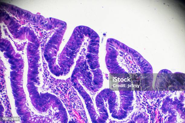 Carcinoma Of The Large Intestine Under Microscope Stock Photo - Download Image Now