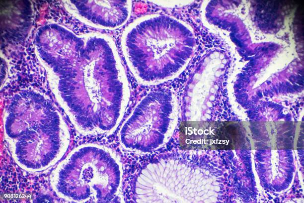 Carcinoma Of The Large Intestine Under Microscope Stock Photo - Download Image Now