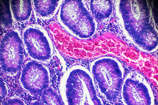 carcinoma del intestino grueso (bien adenocarcinoma tubular diff.) bajo el microscopio - animal cell fotografías e imágenes de stock