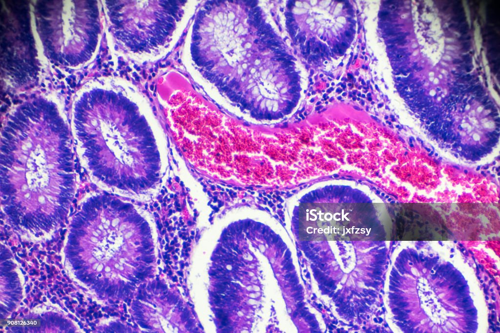 Carcinoma of the large intestine (well diff. tubular adenocarcinoma) under microscope Carcinoma of the large intestine (well diff. tubular adenocarcinoma) under microscope zoom in different areas Cancer Cell Stock Photo