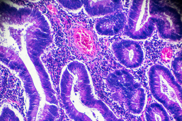 istock Carcinoma of the large intestine (well diff. tubular adenocarcinoma) under microscope 908126458