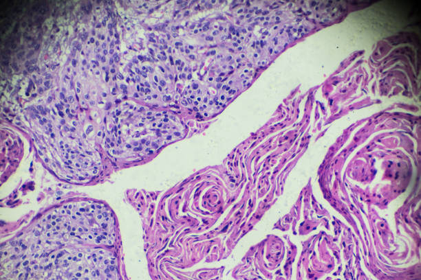 cáncer cervical (carcinoma de célula squamous) bajo microscopia ligera - fotos de virus papiloma humano fotografías e imágenes de stock