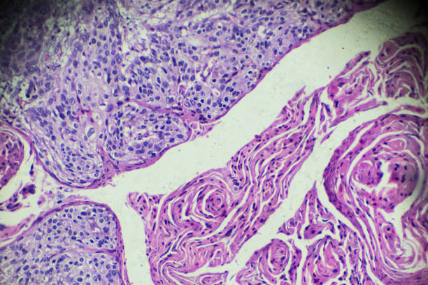 cancro cervicale (carcinoma a cellule squamose) al microscopio leggero - medical sample pathologist laboratory healthcare and medicine foto e immagini stock