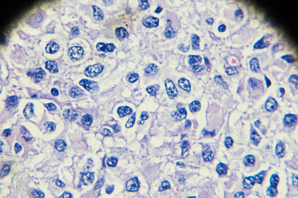 опухоль зародышевых клеток яичка под микроскопом - cancer cell cell cancer human cell стоковые фото и изображения