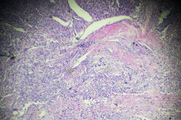Transitional cell cancer of bladder under microscopy Transitional cell cancer of bladder under microscopy zoom in different areas urothelium stock pictures, royalty-free photos & images